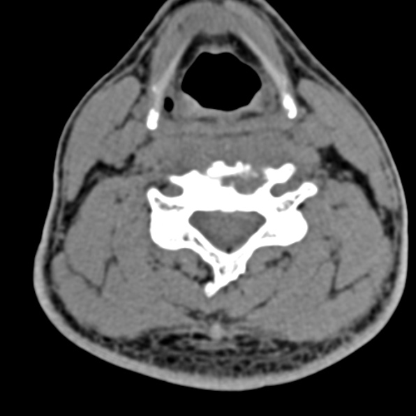 Cervical spondylodiscitis (Radiopaedia 28057-29489 Axial non-contrast 45).jpg
