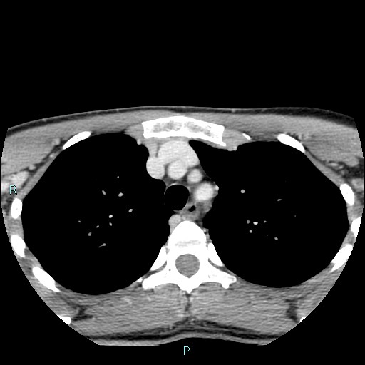 Cervical thymic cyst (Radiopaedia 88632-105335 C 5).jpg