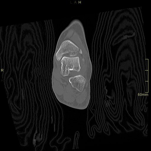 Chaput tubercle fracture (Radiopaedia 80319-93956 Coronal non-contrast 34).jpg