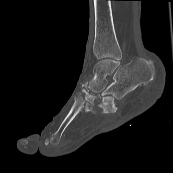 Charcot joint (Radiopaedia 36629-38194 Sagittal bone window 48).jpg