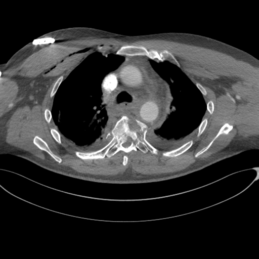 File:Chest multitrauma - aortic injury (Radiopaedia 34708-36147 A 104).png