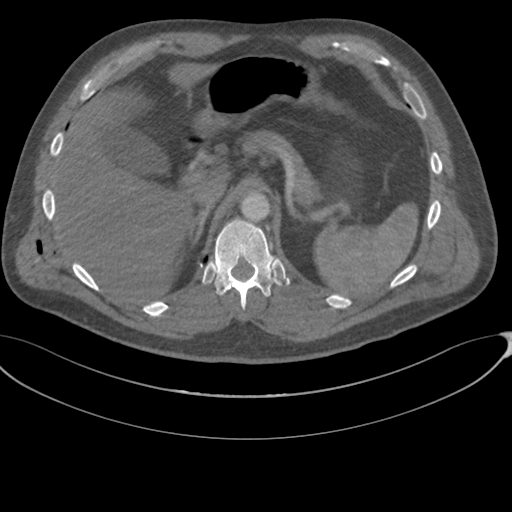 File:Chest multitrauma - aortic injury (Radiopaedia 34708-36147 A 291).png