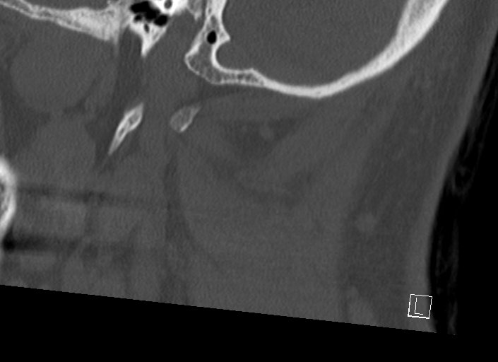 Chiari I malformation with a symptomatic syrinx of the posterolateral medulla oblongata (Radiopaedia 42573-45707 A 50).jpg