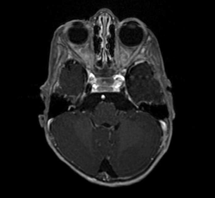 Chiasmatic-hypothalamic glioma (Radiopaedia 90079-107252 Axial T1 C+ 18).jpg
