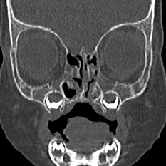 Choanal atresia (Radiopaedia 88525-105975 Coronal bone window 31).jpg
