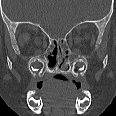 File:Choanal atresia (Radiopaedia 88525-105975 Coronal bone window 49).jpg