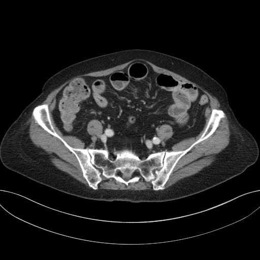 Cholecystoduodenal fistula due to calculous cholecystitis with gallstone migration (Radiopaedia 86875-103077 D 58).jpg