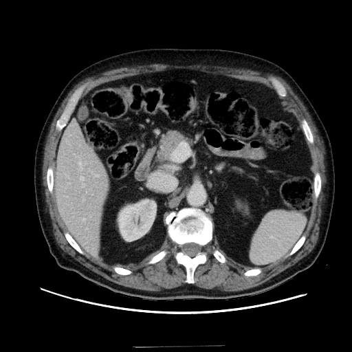 Choledocholiathiasis with normal caliber common bile duct (Radiopaedia 75368-86632 A 69).jpg