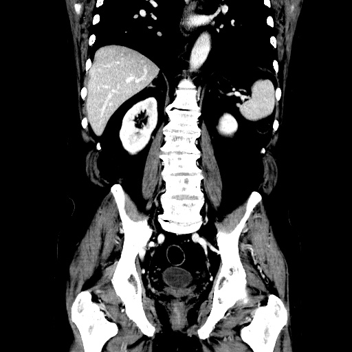 Choledocholiathiasis with normal caliber common bile duct (Radiopaedia 75368-86632 Coronal liver window 84).jpg