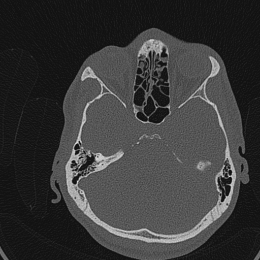 Cholesteatoma (Radiopaedia 70429-80529 Axial bone window 105).jpg