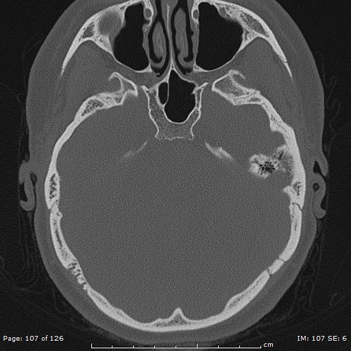 Cholesteatoma - external auditory canal (Radiopaedia 88452-105096 Axial bone window 70).jpg