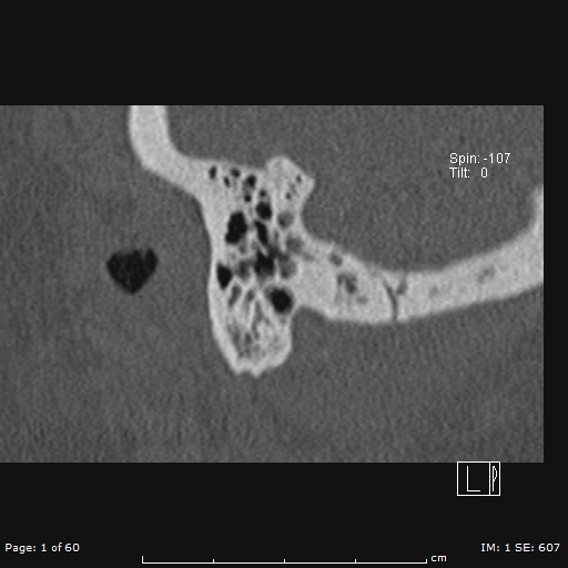 Cholesteatoma - external auditory canal (Radiopaedia 88452-105096 Sagittal bone window 1).jpg
