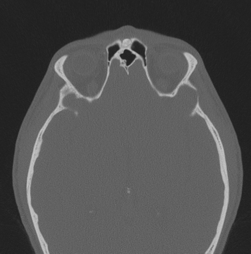 Chondrosarcoma (clivus) (Radiopaedia 46895-51425 Axial bone window 15).png