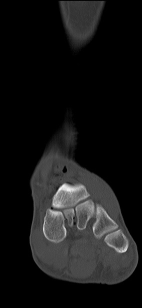 Chopart fracture (Radiopaedia 35347-36851 Coronal bone window 48).jpg