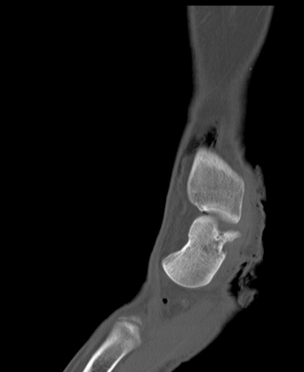 Chopart fracture (Radiopaedia 35347-36851 Sagittal bone window 21).jpg