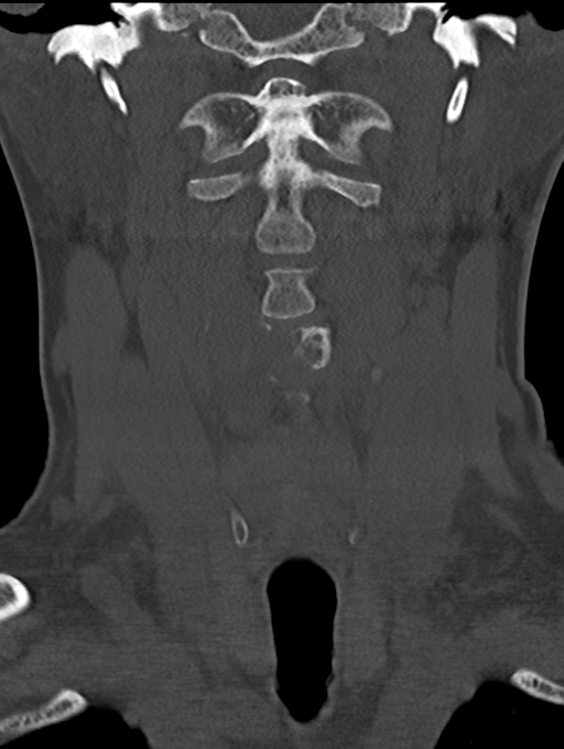 Chordoma (C4 vertebra) (Radiopaedia 47561-52188 Coronal bone window 12).png