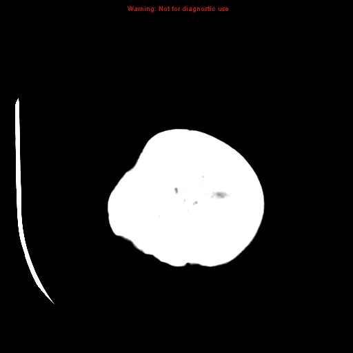 File:Choroid plexus carcinoma - recurrent (Radiopaedia 8330-9168 Axial non-contrast 27).jpg
