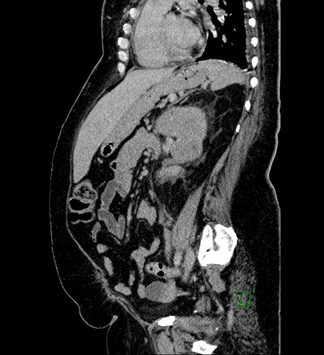 Chromophobe renal cell carcinoma (Radiopaedia 84239-99519 G 47).jpg