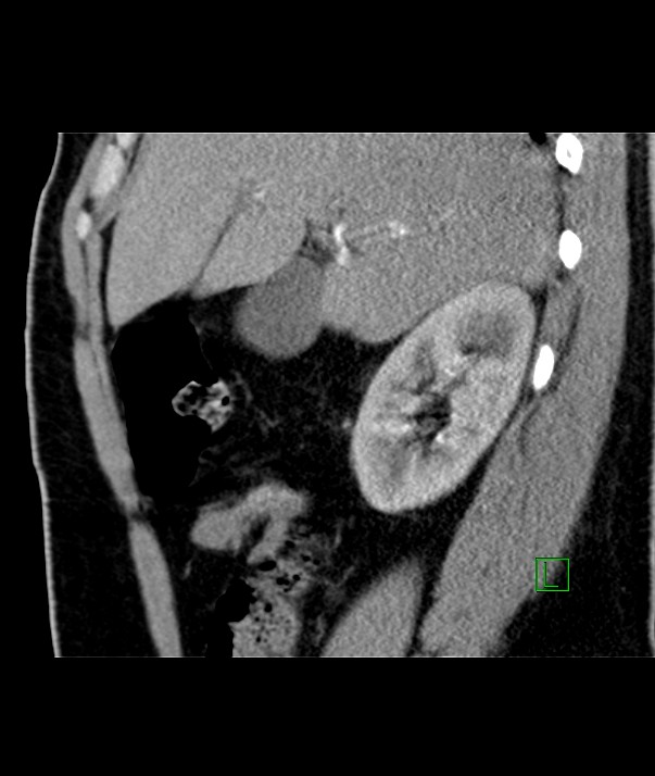 Chromophobe renal cell carcinoma (Radiopaedia 84255-99542 E 42).jpg