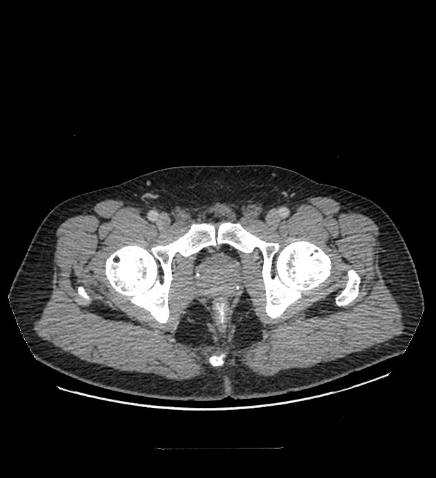 Chromophobe renal cell carcinoma (Radiopaedia 84337-99644 C 132).jpg