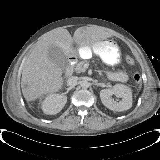 Chronic diverticulitis complicated by hepatic abscess and portal vein thrombosis (Radiopaedia 30301-30938 A 36).jpg