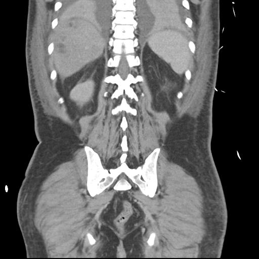 Chronic diverticulitis complicated by hepatic abscess and portal vein thrombosis (Radiopaedia 30301-30938 B 47).jpg