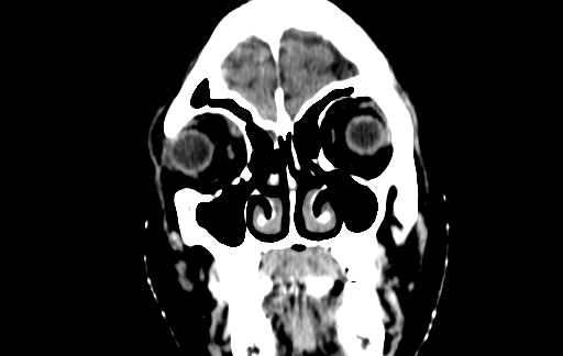 Chronic invasive fungal sinusitis (Radiopaedia 91563-109286 D 8).jpg