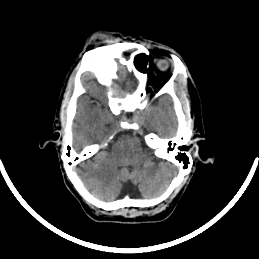Chronic invasive fungal sinusitis with intraorbital and intracranial extension (Radiopaedia 56387-63046 Axial non-contrast 138).jpg