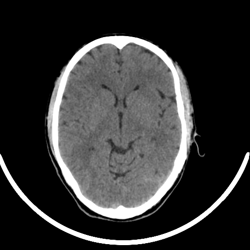 Chronic invasive fungal sinusitis with intraorbital and intracranial extension (Radiopaedia 56387-63046 Axial non-contrast 190).jpg