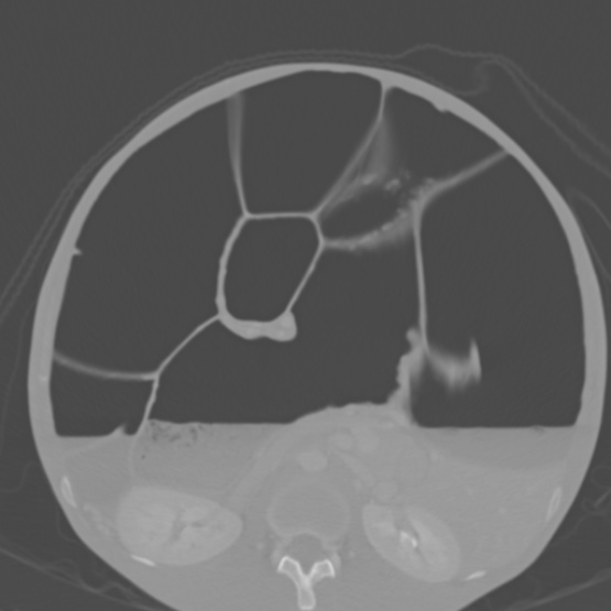 File:Chronic large bowel pseudo-obstruction (Radiopaedia 43181-46492 Axial bone window 83).jpg