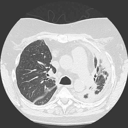 Chronic lung allograft dysfunction - restrictive form (Radiopaedia 60595-68316 Axial lung window 25).jpg