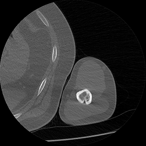 Chronic osteomyelitis (Radiopaedia 67597-76998 Axial bone window 40).jpg