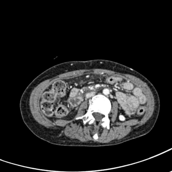 Chronic pancreatitis (Radiopaedia 55405-61846 A 54).jpg