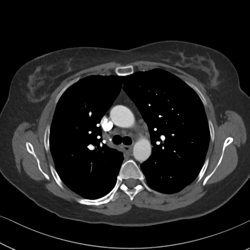Chronic pulmonary embolus (Radiopaedia 39129-41341 Axial C+ CTPA 39).png