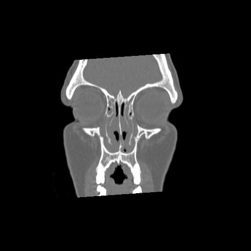 File:Chronic sinusitis with intra-sinus calcification (Radiopaedia 63919-72668 Coronal bone window 7).jpg