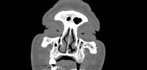 Chronic sphenoidal sinusitis (Radiopaedia 62030-70122 Coronal bone window 18).jpg