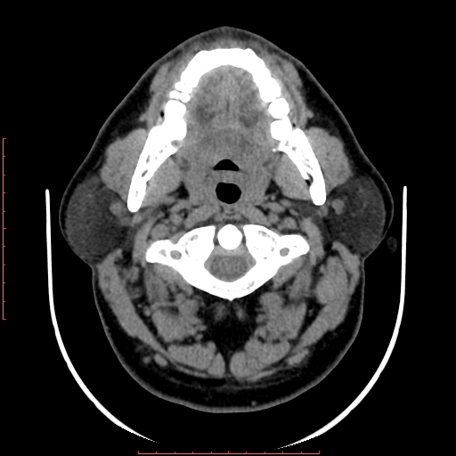 Chronic submandibular sialolithiasis (Radiopaedia 69817-79814 Axial non-contrast 68).jpg
