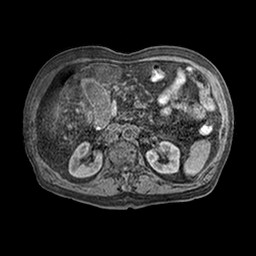 Cirrhosis and hepatocellular carcinoma in the setting of hemochromatosis (Radiopaedia 75394-86594 Axial T1 C+ fat sat 26).jpg