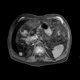 Cirrhosis and hepatocellular carcinoma in the setting of hemochromatosis (Radiopaedia 75394-86594 Axial T1 C+ fat sat 43).jpg