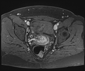 File:Class II Mullerian duct anomaly- unicornuate uterus with rudimentary horn and non-communicating cavity (Radiopaedia 39441-41755 Axial T1 fat sat 82).jpg