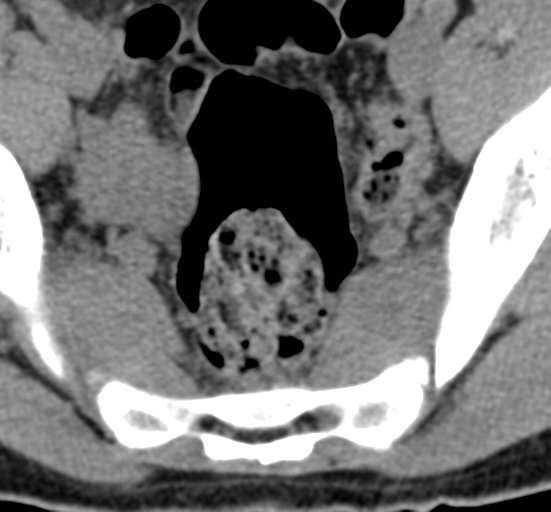 File:Clear cell meningoma - lumbar spine (Radiopaedia 60116-67691 Axial non-contrast 84).png