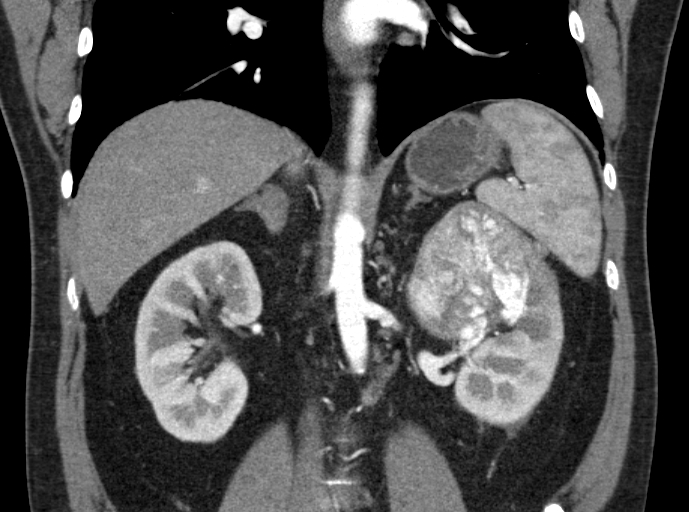 File:Clear cell renal cell carcinoma (Radiopaedia 61449-69393 C 23).jpg
