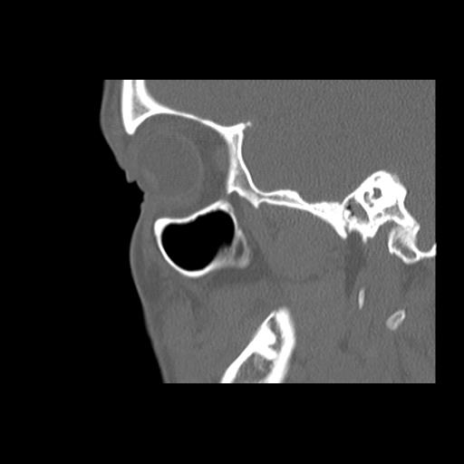 Cleft hard palate and alveolus (Radiopaedia 63180-71710 Sagittal bone window 15).jpg