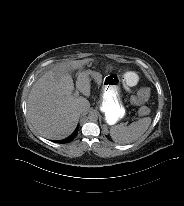 Closed-loop small bowel obstruction-internal hernia (Radiopaedia 78439-91096 Axial non-contrast 34).jpg