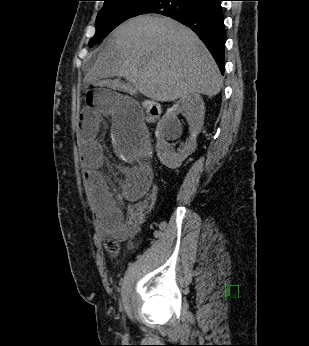 Closed-loop small bowel obstruction-internal hernia (Radiopaedia 78439-91096 C 105).jpg