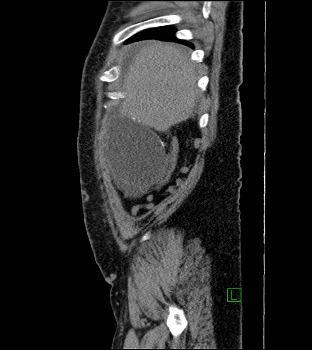 Closed-loop small bowel obstruction-internal hernia (Radiopaedia 78439-91096 C 125).jpg