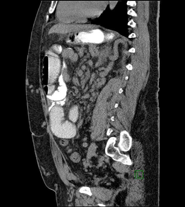 Closed-loop small bowel obstruction-internal hernia (Radiopaedia 78439-91096 C 65).jpg