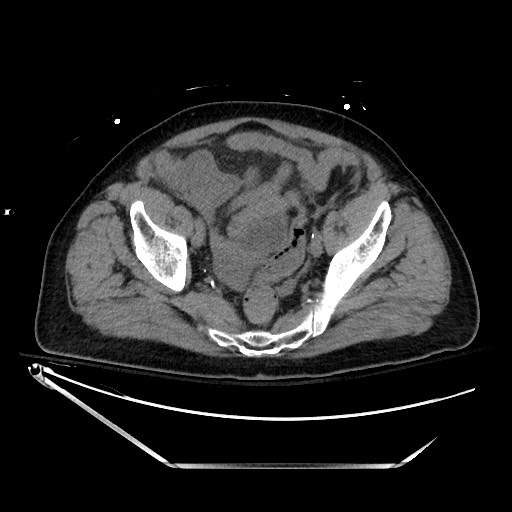 Closed loop obstruction due to adhesive band, resulting in small bowel ischemia and resection (Radiopaedia 83835-99023 Axial non-contrast 129).jpg