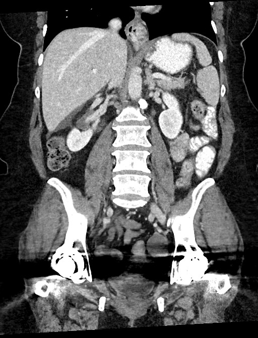 Closed loop small bowel obstruction - adhesions (Radiopaedia 59078-66369 B 72).jpg