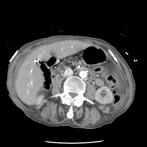 Closed loop small bowel obstruction - adhesions and infarct (Radiopaedia 85125-100678 A 81).jpg